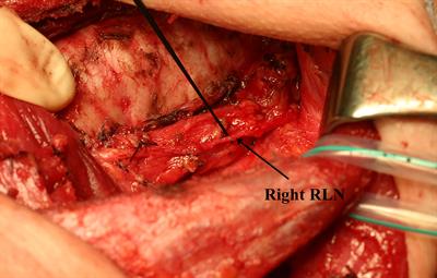 Intraoperative Management of the Recurrent Laryngeal Nerve Transected or Invaded by Thyroid Cancer